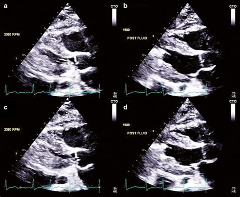 underfilled left ventricle.